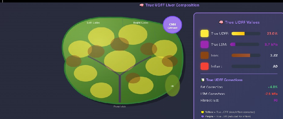 True UDFF liver composition map with quantified fat, stiffness, iron and inflammation values