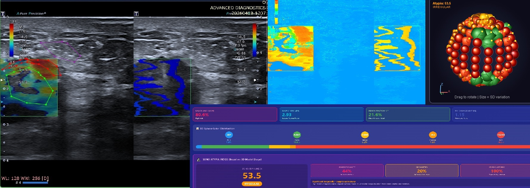SonoHistology workspace with B-mode and elastography imaging, malignancy score, and a 3D atypia model